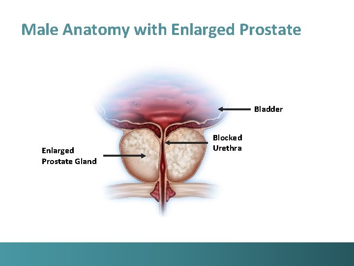 Male Anatomy with Enlarged Prostate Bladder Enlarged Prostate Gland Blocked Urethra 