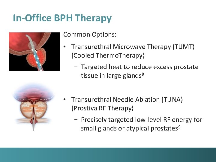 In-Office BPH Therapy Common Options: • Transurethral Microwave Therapy (TUMT) (Cooled Thermo. Therapy) −