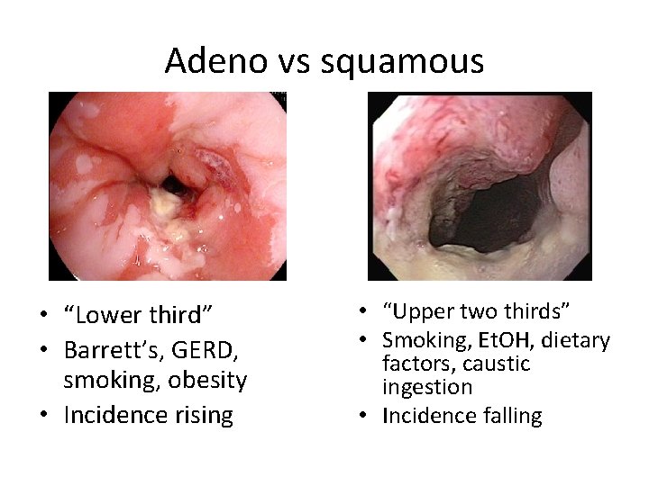 Adeno vs squamous • “Lower third” • Barrett’s, GERD, smoking, obesity • Incidence rising