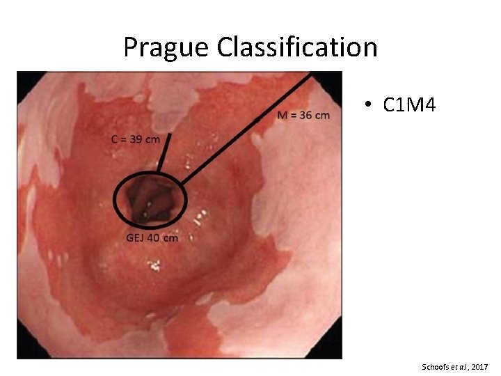 Prague Classification • C 1 M 4 Schoofs et al. , 2017 