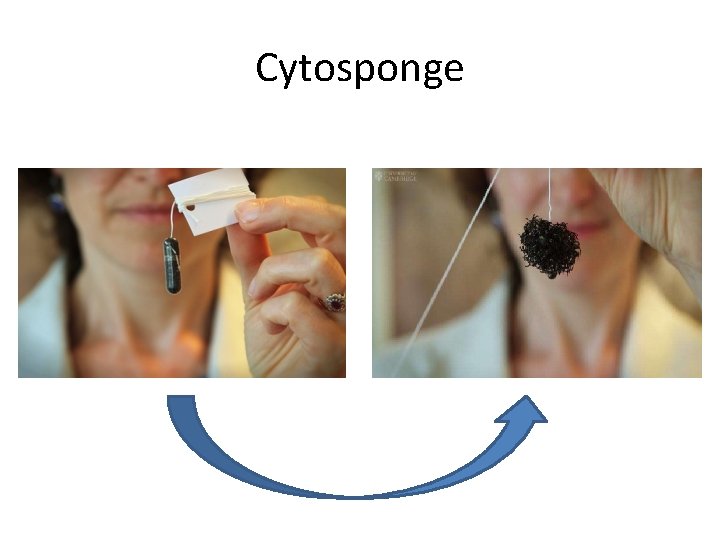 Cytosponge 