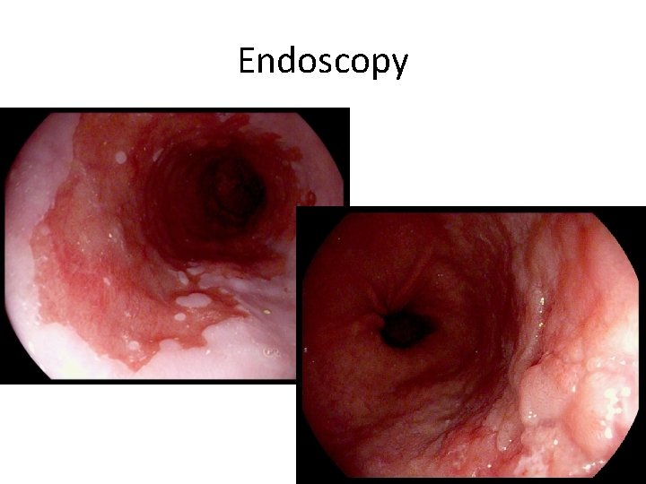 Endoscopy 