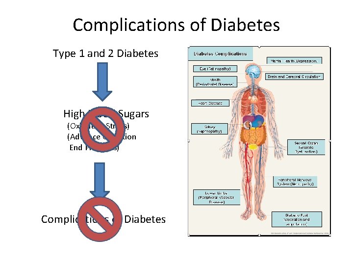Complications of Diabetes Type 1 and 2 Diabetes High Blood Sugars (Oxidative Stress) (Advance