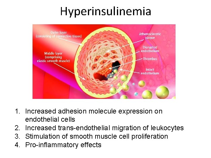 Hyperinsulinemia 1. Increased adhesion molecule expression on endothelial cells 2. Increased trans-endothelial migration of