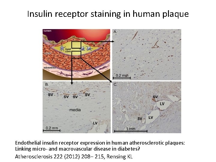 Insulin receptor staining in human plaque Endothelial insulin receptor expression in human atherosclerotic plaques: