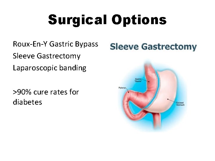 Surgical Options Roux-En-Y Gastric Bypass Sleeve Gastrectomy Laparoscopic banding >90% cure rates for diabetes