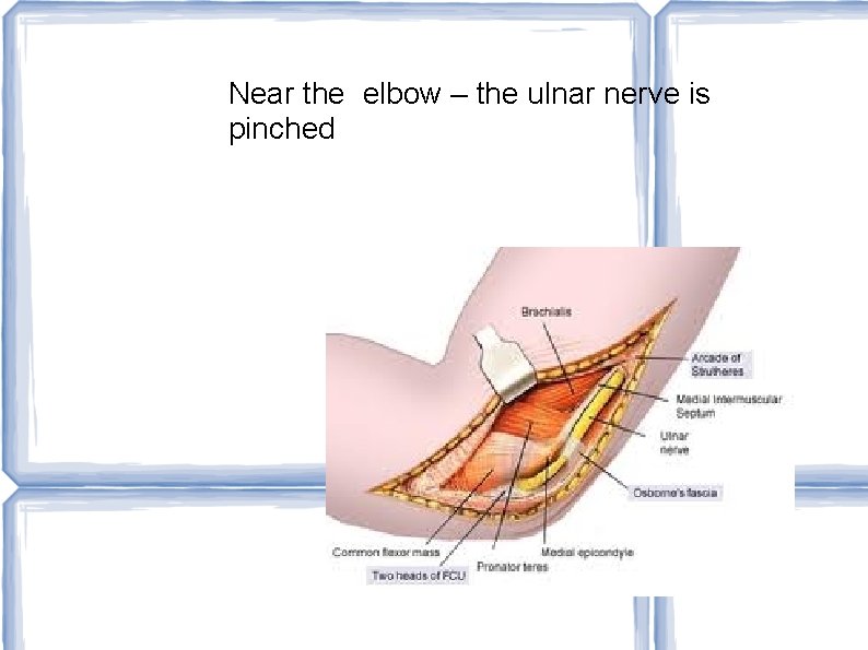 Near the elbow – the ulnar nerve is pinched 