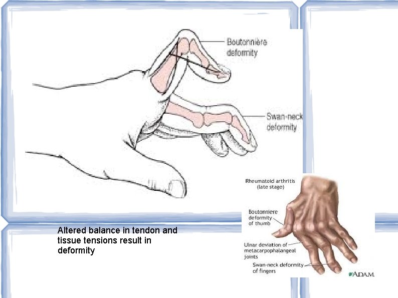 Altered balance in tendon and tissue tensions result in deformity 