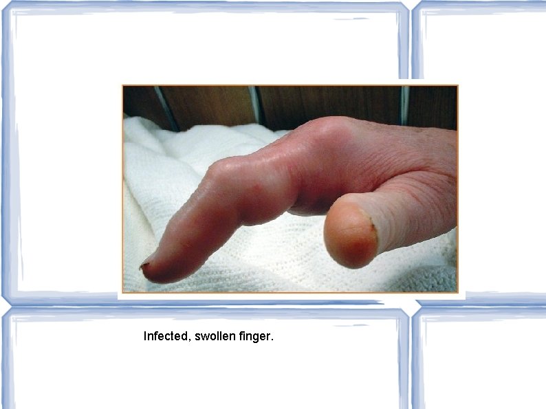 Infected, swollen finger. 