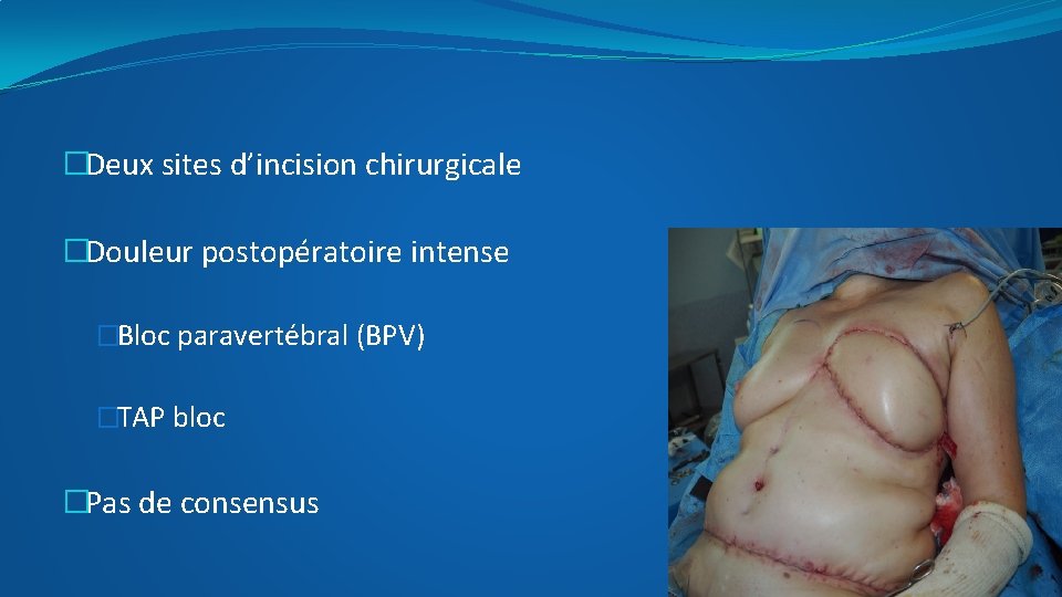 �Deux sites d’incision chirurgicale �Douleur postopératoire intense �Bloc paravertébral (BPV) �TAP bloc �Pas de