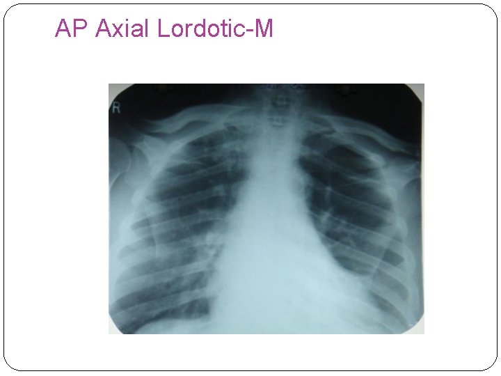 AP Axial Lordotic-M 