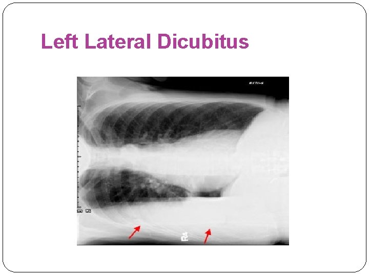 Left Lateral Dicubitus 