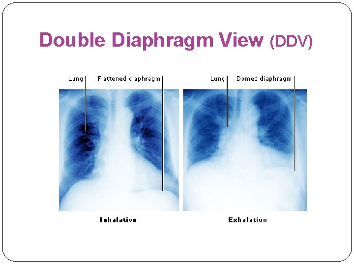 Double Diaphragm View (DDV) 