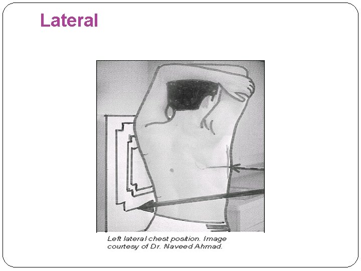 Lateral 