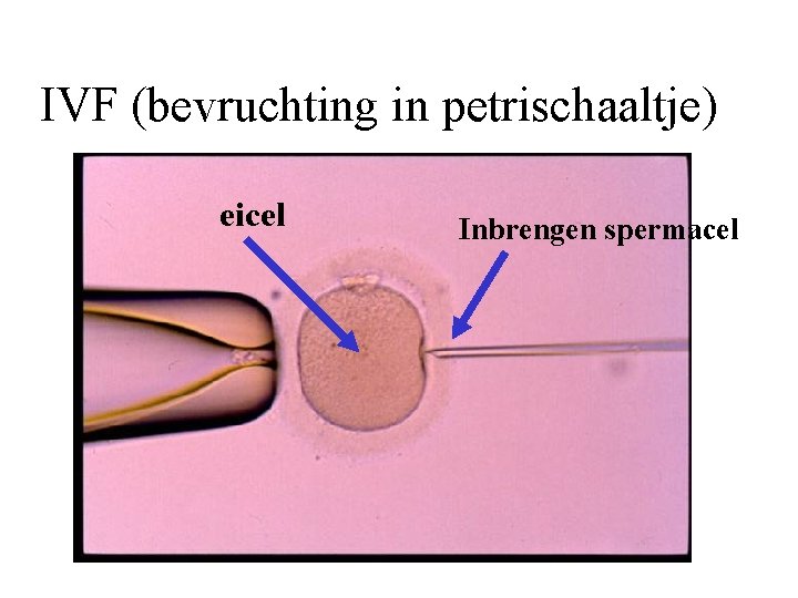 IVF (bevruchting in petrischaaltje) eicel Inbrengen spermacel 