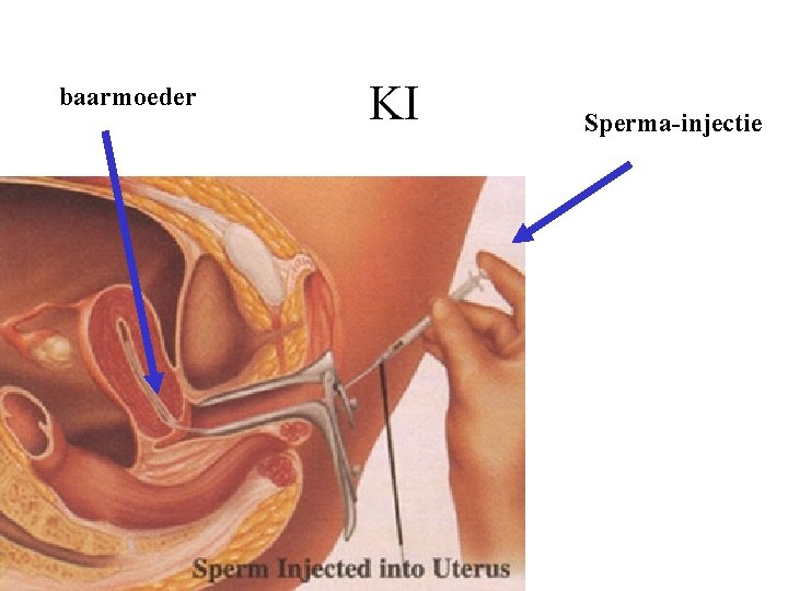 baarmoeder KI Sperma-injectie 