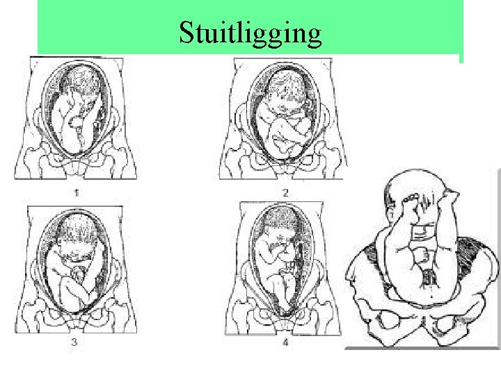 Stuitligging 