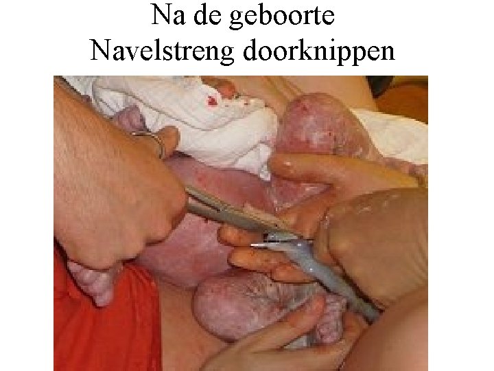 Na de geboorte Navelstreng doorknippen 