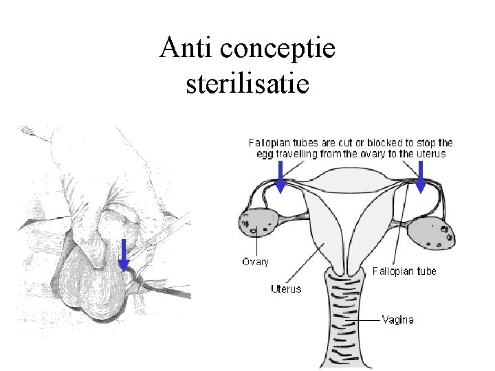 Anti conceptie sterilisatie 