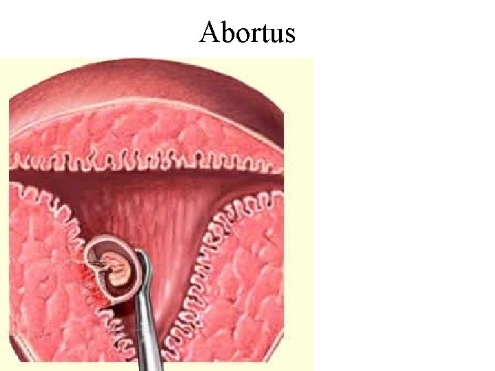 Abortus 