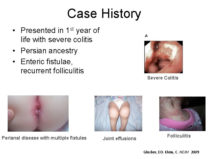 Case History • Presented in 1 st year of life with severe colitis •