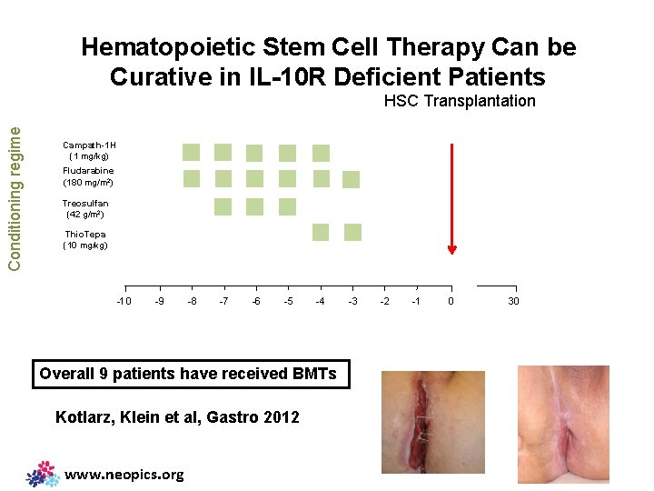 Hematopoietic Stem Cell Therapy Can be Curative in IL-10 R Deficient Patients Conditioning regime