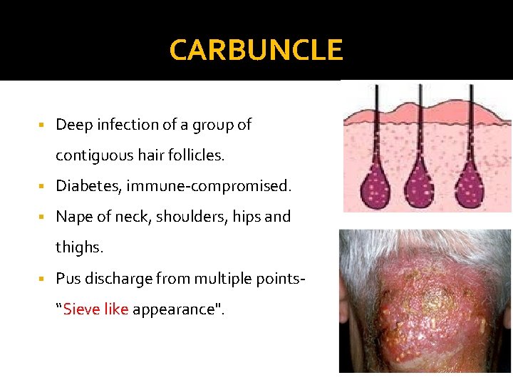 CARBUNCLE § Deep infection of a group of contiguous hair follicles. § Diabetes, immune-compromised.