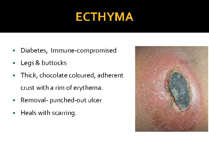 ECTHYMA § Diabetes, Immune-compromised § Legs & buttocks § Thick, chocolate coloured, adherent crust