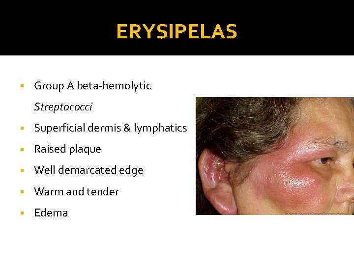 ERYSIPELAS § Group A beta-hemolytic Streptococci § Superficial dermis & lymphatics § Raised plaque