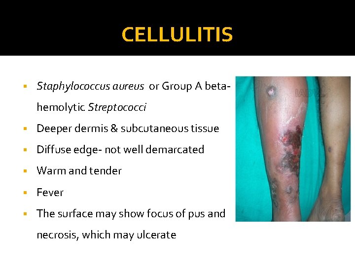 CELLULITIS § Staphylococcus aureus or Group A betahemolytic Streptococci § Deeper dermis & subcutaneous