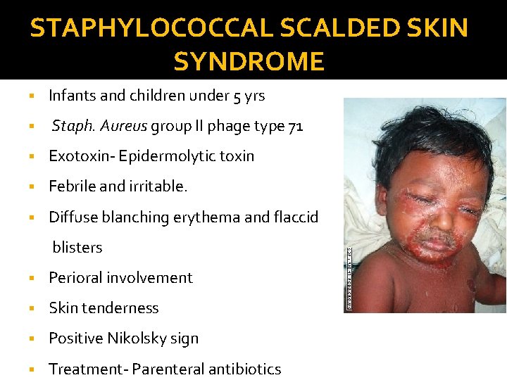 STAPHYLOCOCCAL SCALDED SKIN SYNDROME § Infants and children under 5 yrs § Staph. Aureus