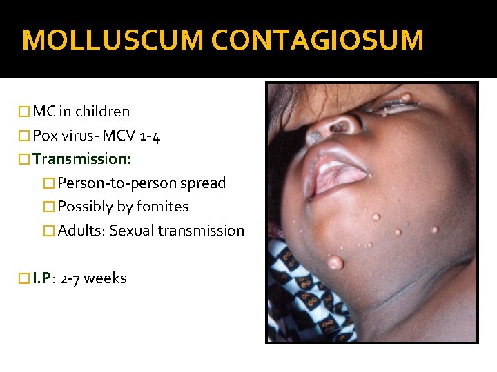 MOLLUSCUM CONTAGIOSUM � MC in children � Pox virus- MCV 1 -4 � Transmission: