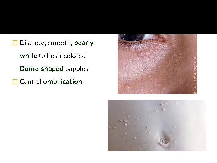 � Discrete, smooth, pearly white to flesh-colored Dome-shaped papules � Central umbilication 