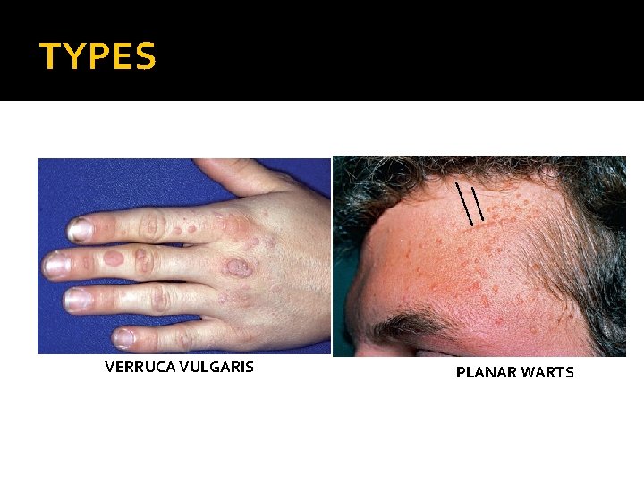 TYPES VERRUCA VULGARIS PLANAR WARTS 