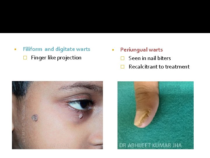 § Filiform and digitate warts � Finger like projection § Periungual warts � Seen