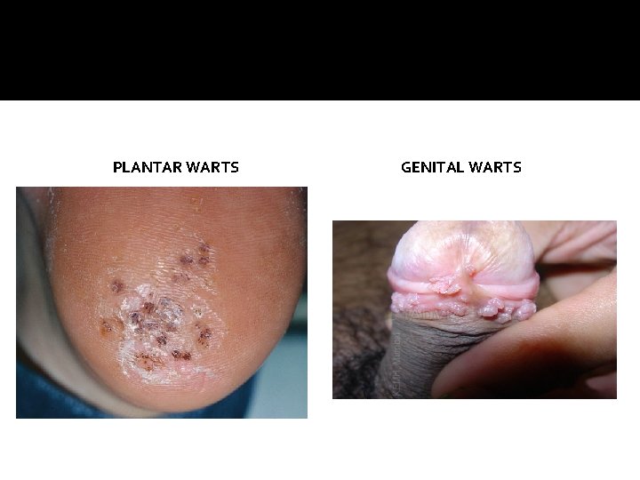 PLANTAR WARTS GENITAL WARTS 