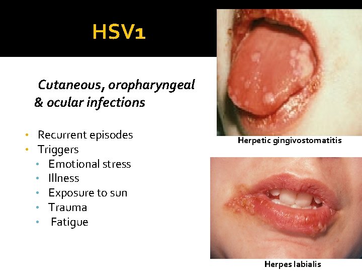  HSV 1 Cutaneous, oropharyngeal & ocular infections • • Recurrent episodes Triggers •