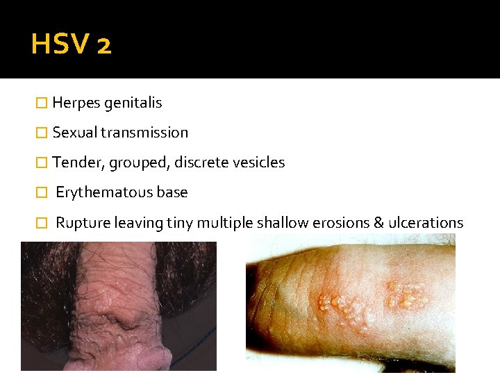 HSV 2 � Herpes genitalis � Sexual transmission � Tender, grouped, discrete vesicles �