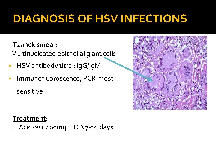 DIAGNOSIS OF HSV INFECTIONS Tzanck smear: Multinucleated epithelial giant cells § HSV antibody titre