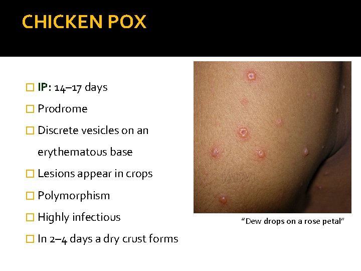 CHICKEN POX � IP: 14– 17 days � Prodrome � Discrete vesicles on an