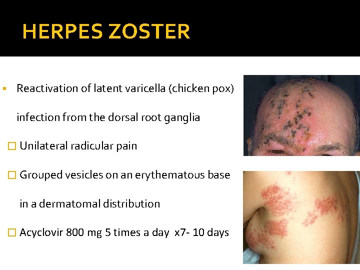 HERPES ZOSTER § Reactivation of latent varicella (chicken pox) infection from the dorsal root