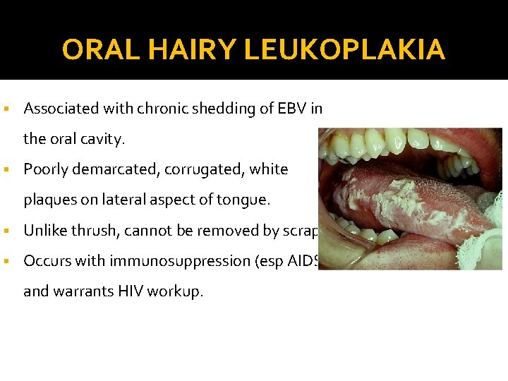 ORAL HAIRY LEUKOPLAKIA § Associated with chronic shedding of EBV in the oral cavity.