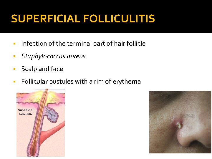SUPERFICIAL FOLLICULITIS § Infection of the terminal part of hair follicle § Staphylococcus aureus