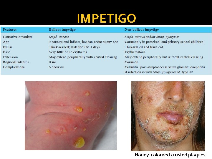 IMPETIGO Honey-coloured crusted plaques 