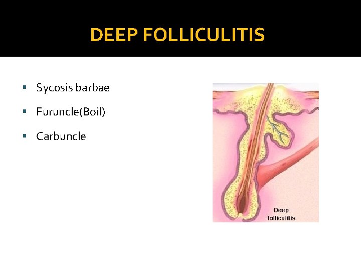 DEEP FOLLICULITIS § Sycosis barbae § Furuncle(Boil) § Carbuncle 