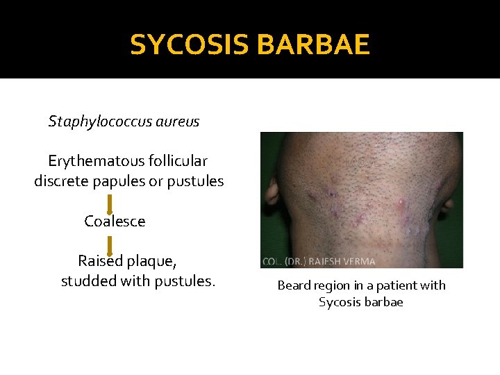 SYCOSIS BARBAE Staphylococcus aureus Erythematous follicular discrete papules or pustules Coalesce Raised plaque, studded