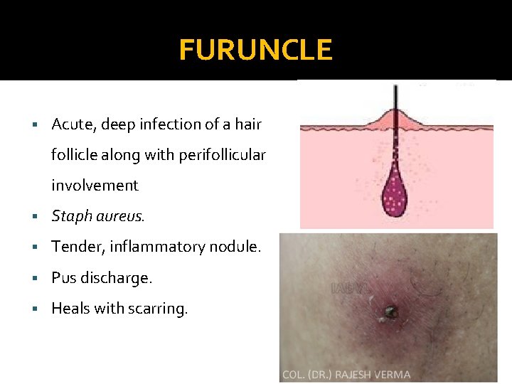 FURUNCLE § Acute, deep infection of a hair follicle along with perifollicular involvement §