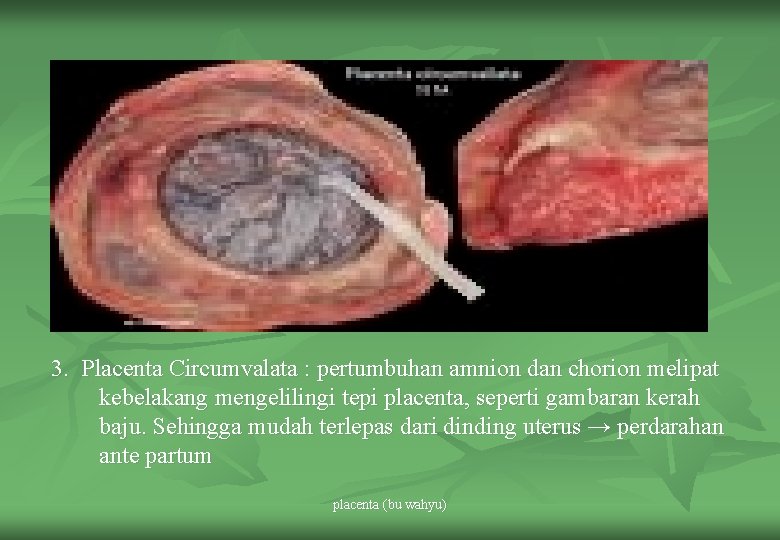 3. Placenta Circumvalata : pertumbuhan amnion dan chorion melipat kebelakang mengelilingi tepi placenta, seperti