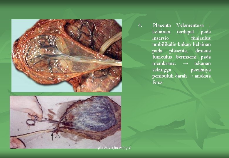 4. placenta (bu wahyu) Placenta Velamentosa : kelainan terdapat pada insersio funiculus umbilikalis bukan