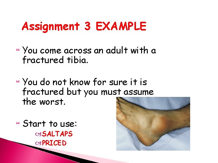 Assignment 3 EXAMPLE You come across an adult with a fractured tibia. You do